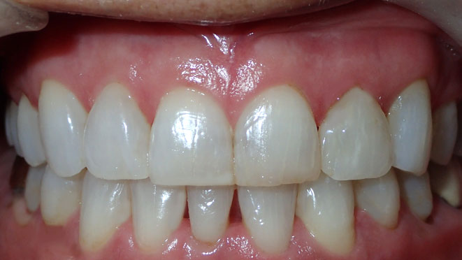 Adult-Invisalign-Cecelia-Reyna-Teeth-After