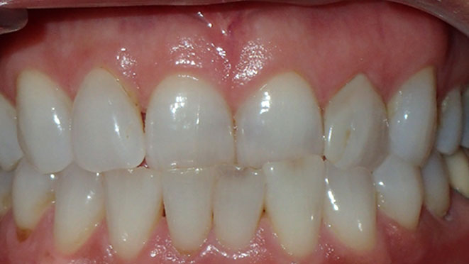 Adult-Invisalign-Cecelia-Reyna-Teeth-Before