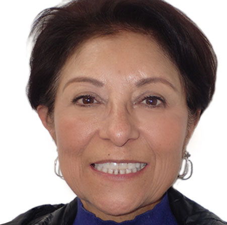 dult-Invisalign-Cecilia-Reyna-Face-After