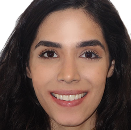 Adult-Invisalign-Gabriela-Mendoza-Face-Afte