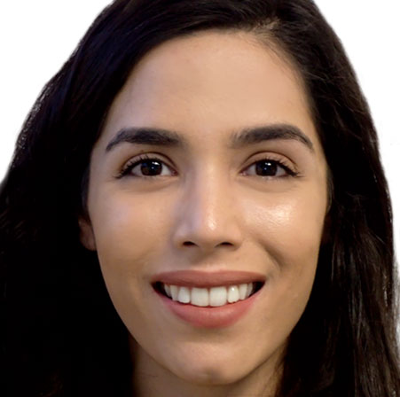 Adult-Invisalign-Gabriela-Mendoza-Face-Before