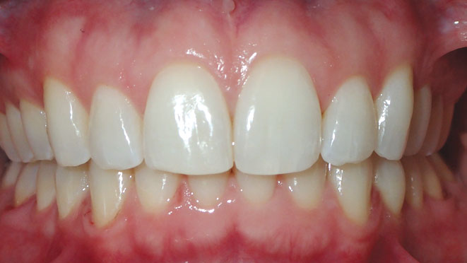 Adult-Invisalign-Gabriela-Mendoza-Teeth-After