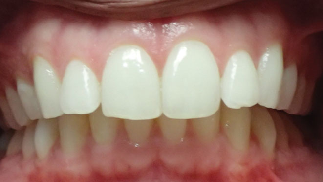 Adult-Invisalign-Gabriela-Mendoza-Teeth-Before