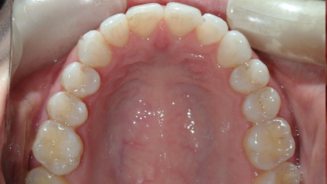 Adult-Invisalign-Veronica-Barth-Teeth-After