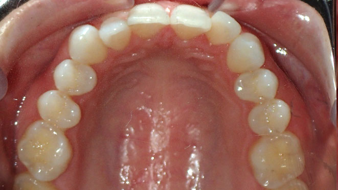 Adult-Invisalign-Veronica-Barth-Teeth-Before