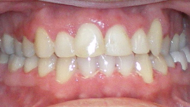 Adult-braces-EE-Teeth-After