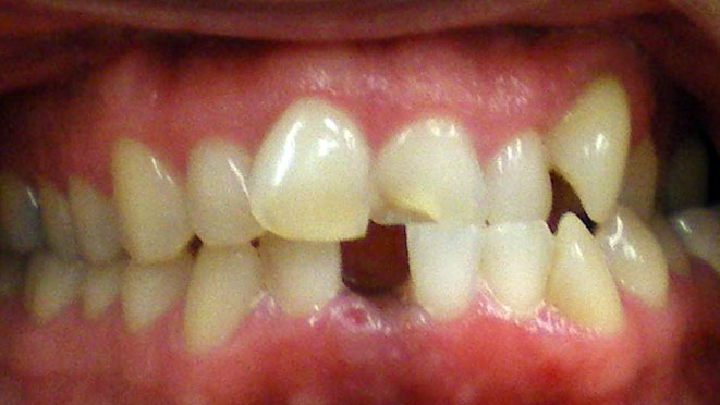 Adult-braces-EE-Teeth-Before