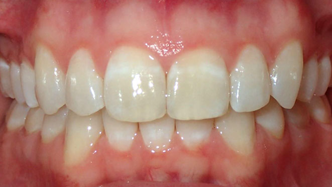 Adult-invisalign-AD-Teeth-after
