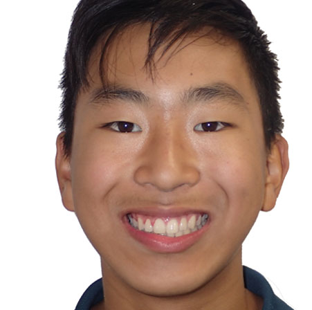 Teen-Braces-Hayden-Song-Face-After