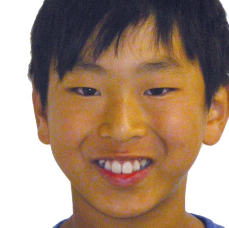 Teen-Braces-Hayden-Song-Face-Before