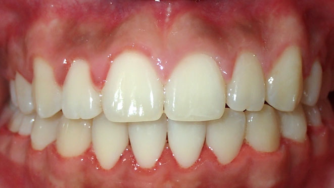 Teen-Braces-Hayden-Song-Teeth-After