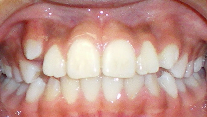 Teen-Braces-Hayden-Song-Teeth-Before