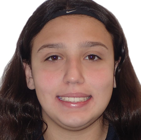 Teen-Braces-Isabella-Marqez-Face-After