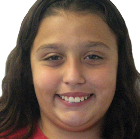 Teen-Braces-Isabella-Marquez-Face-Before