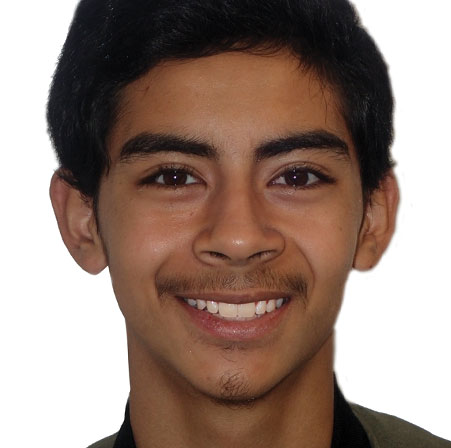 Teen-Braces-Michael-Valencia-Face-After