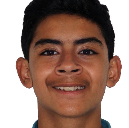 Teen-Braces-Michael-Valencia-Face-Before
