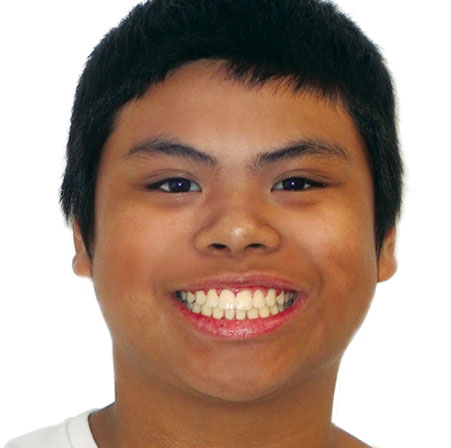 Teen-Braces-Raphael-Fontejon-Face-After