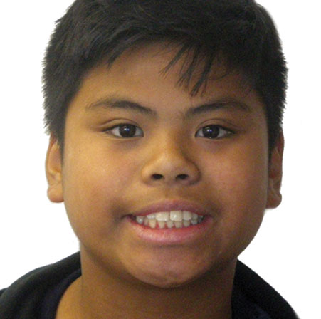 Teen-Braces-Raphael-Fontejon-Face-Before