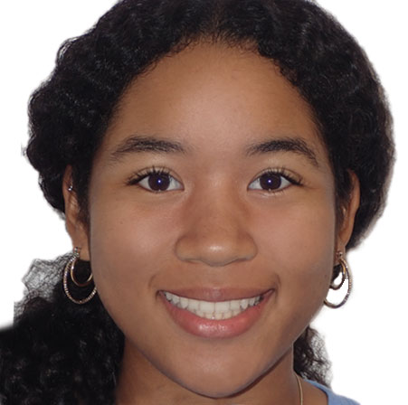 Teen-Invisalign-Demi-Norman-Face-After