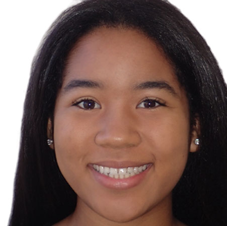 Teen-Invisalign-Demi-Norman-Face-Before