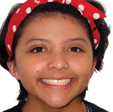 Teen-Invisalign-Kayla-Guttierez-Face-After