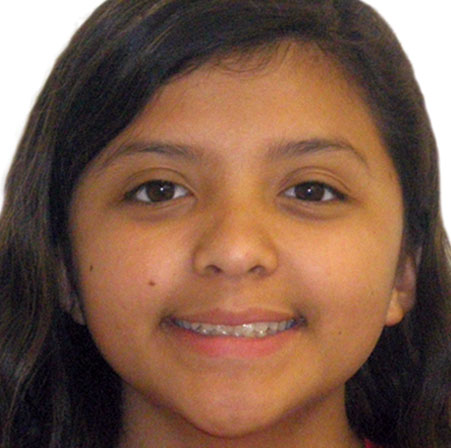 Teen-Invisalign-Kayla-Guttierez-Face-Before