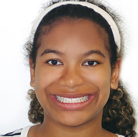 Teen-Invisalign-Nia-Johnson-Face-After