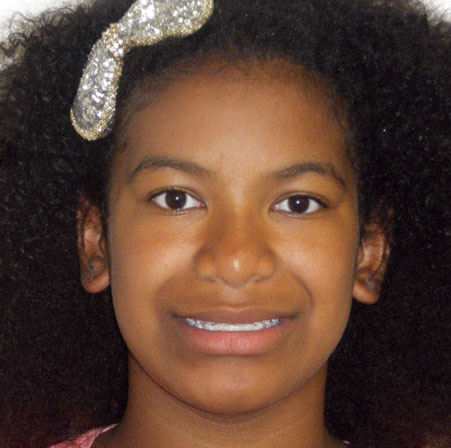 Teen-Invisalign-Nia-Johnson-Face-Before