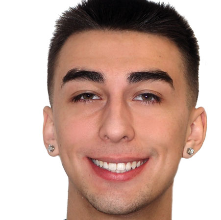 Teen-Invisalign-Reyce-Holguin-Face-After