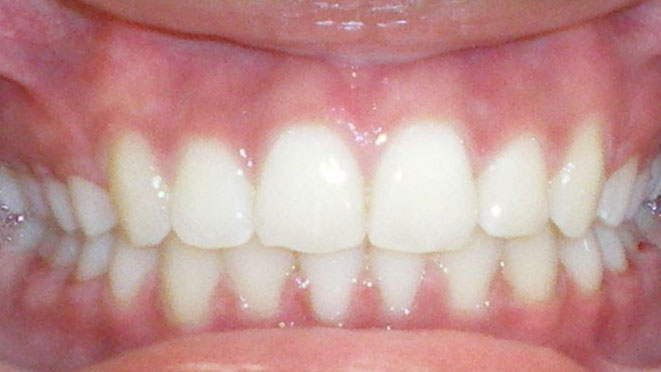 Teen-braces-PG-Teeth-After