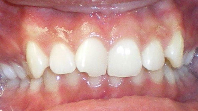 Teen-braces-PG-Teeth-Before