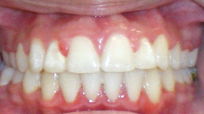 Teen-braces-VL-Teeth-After