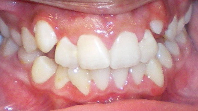 Teen-braces-VL-Teeth-Before