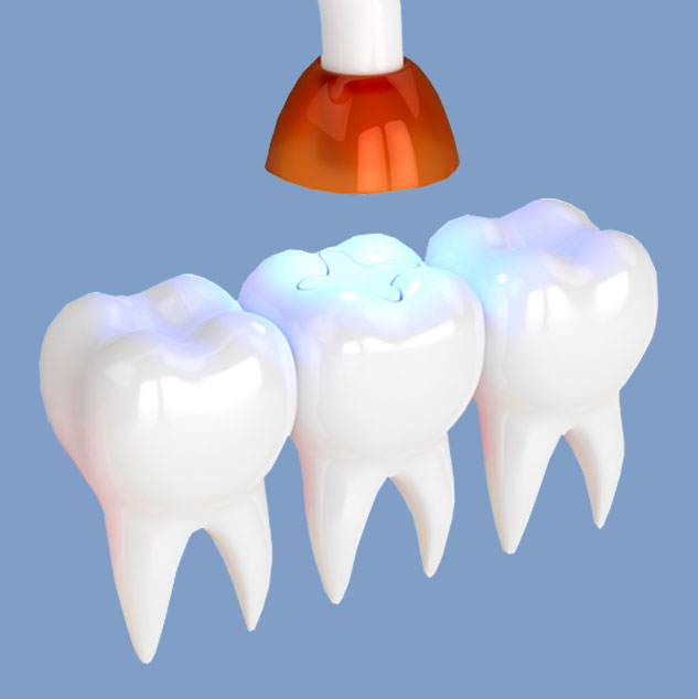 Mercury Free Fillings
