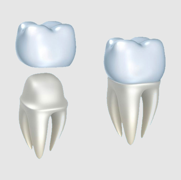 Dental crown options